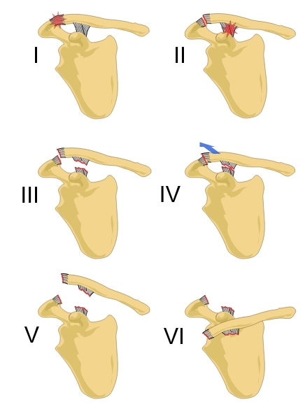 Dor na articulação AC / Lesão acromioclavicular