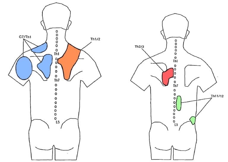 Physiotherapy for Thoracic Pain