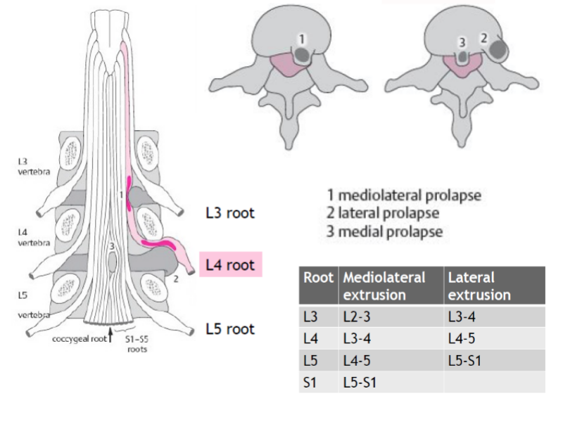 Syndrome radiculaire lombaire | Diagnostic et traitement pour les ...